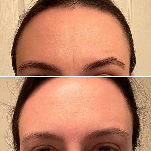 Frownies Forehead & Between Eyes Wrinkle Patches